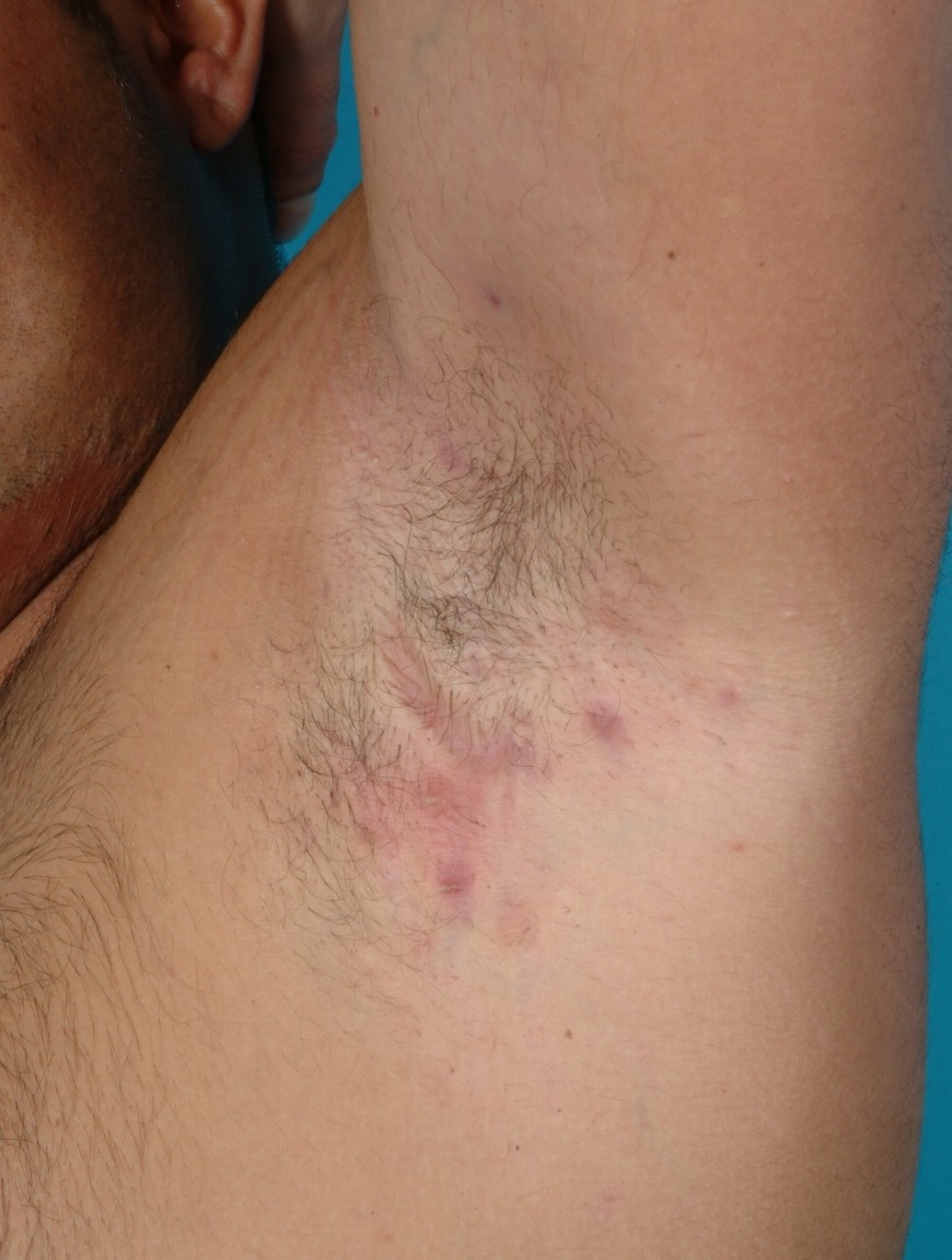 Hidradenitis suppurativa with inflamed bumps and scarring in the underarm