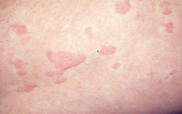 Raised wheals in a clinical example of hives