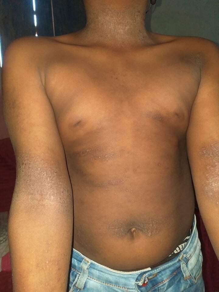Thickened skin in lichen simplex chronicus, one possible consequence of persistent scratching
