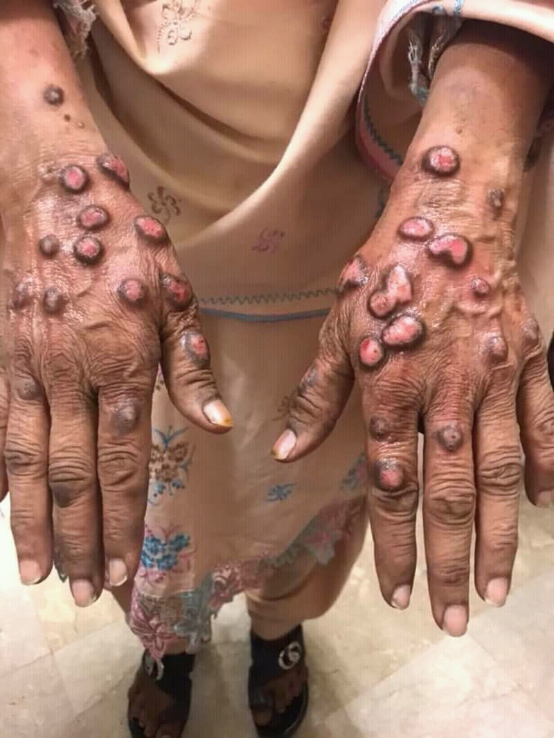 Multiple nodules in a clinical example of prurigo nodularis