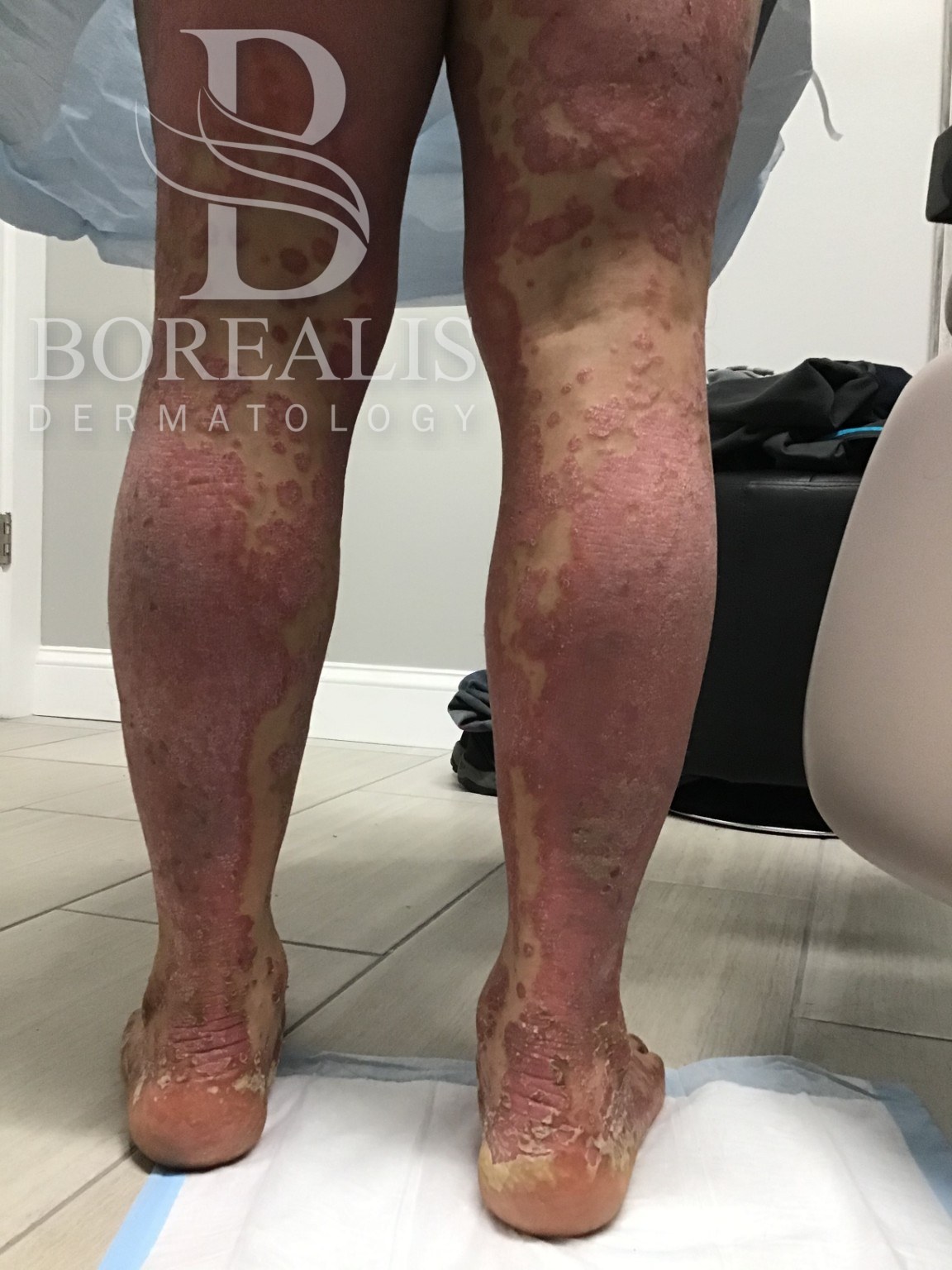Widespread red, scaly psoriasis plaques on both lower legs
