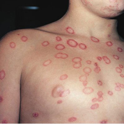 Multiple ring-shaped red patches with central clearing on the chest, shoulder, and neck.