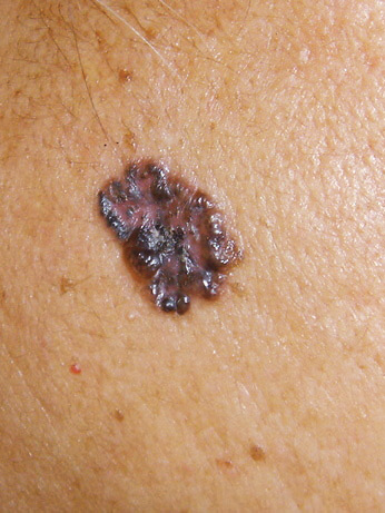 Pigmented basal cell carcinoma on brown skin.
