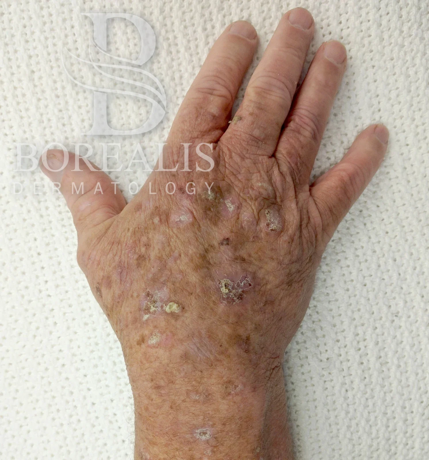 Actinic keratosis on the back of a hand