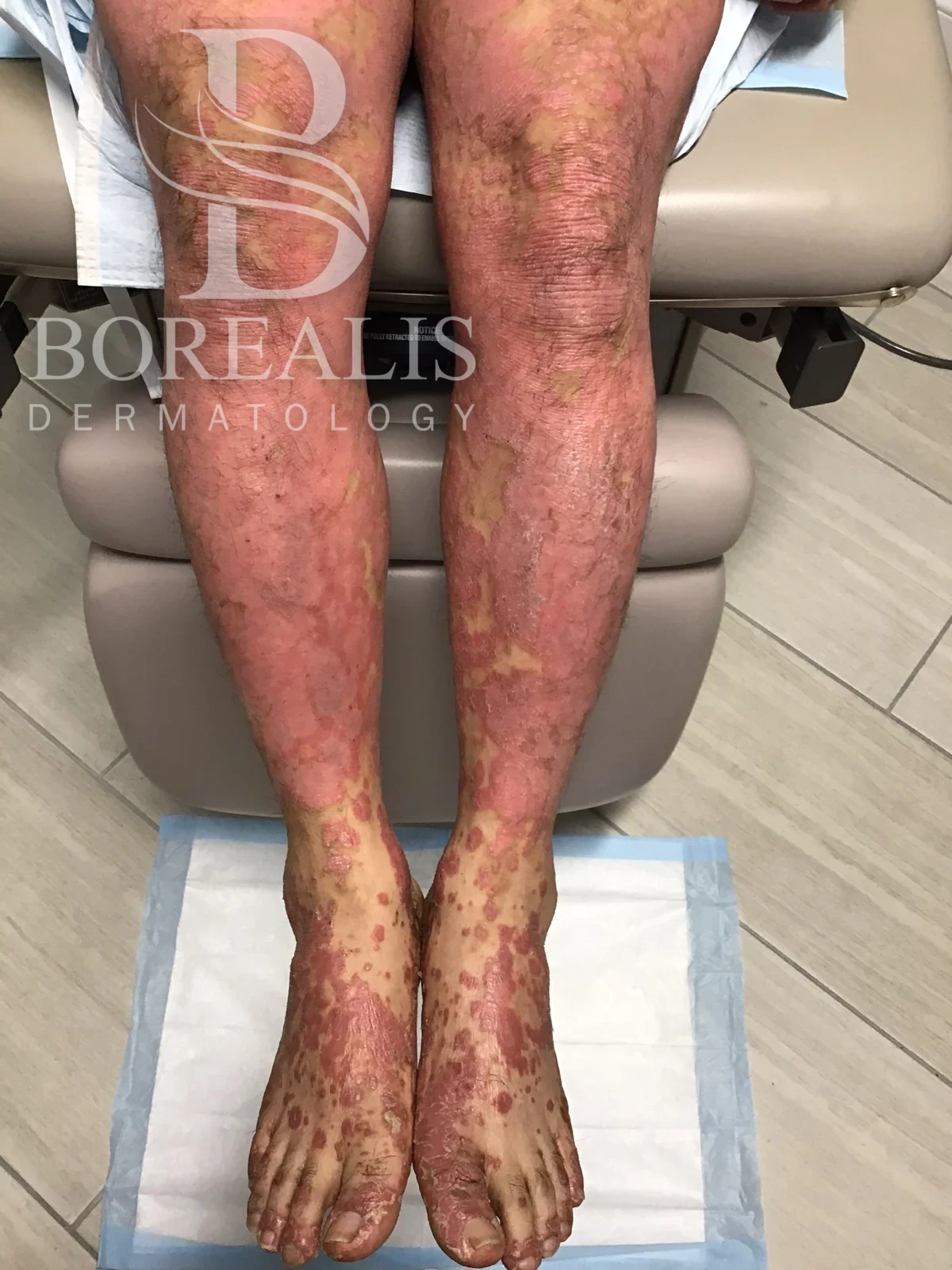 累及双腿和足部的银屑病临床照片