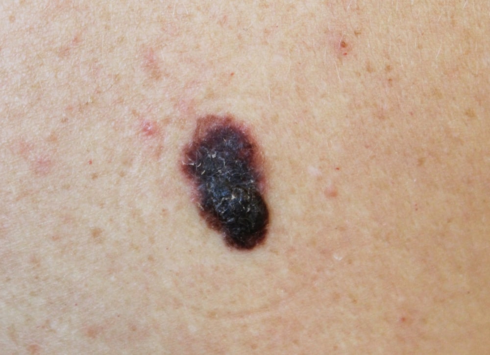 a malignant tumor of human skin