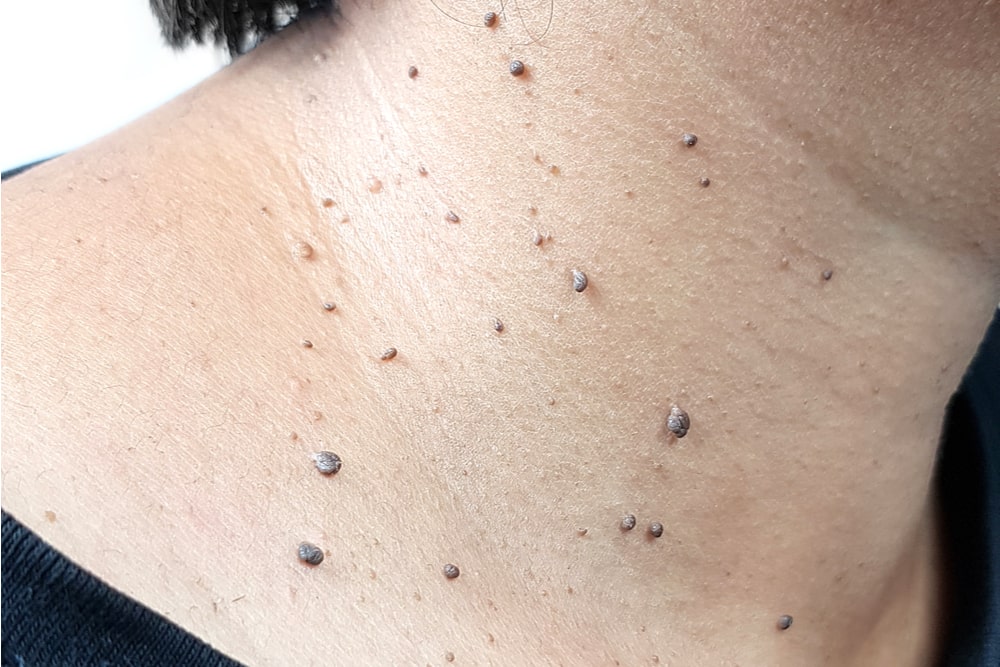 The skin tags on woman's skin on the neck