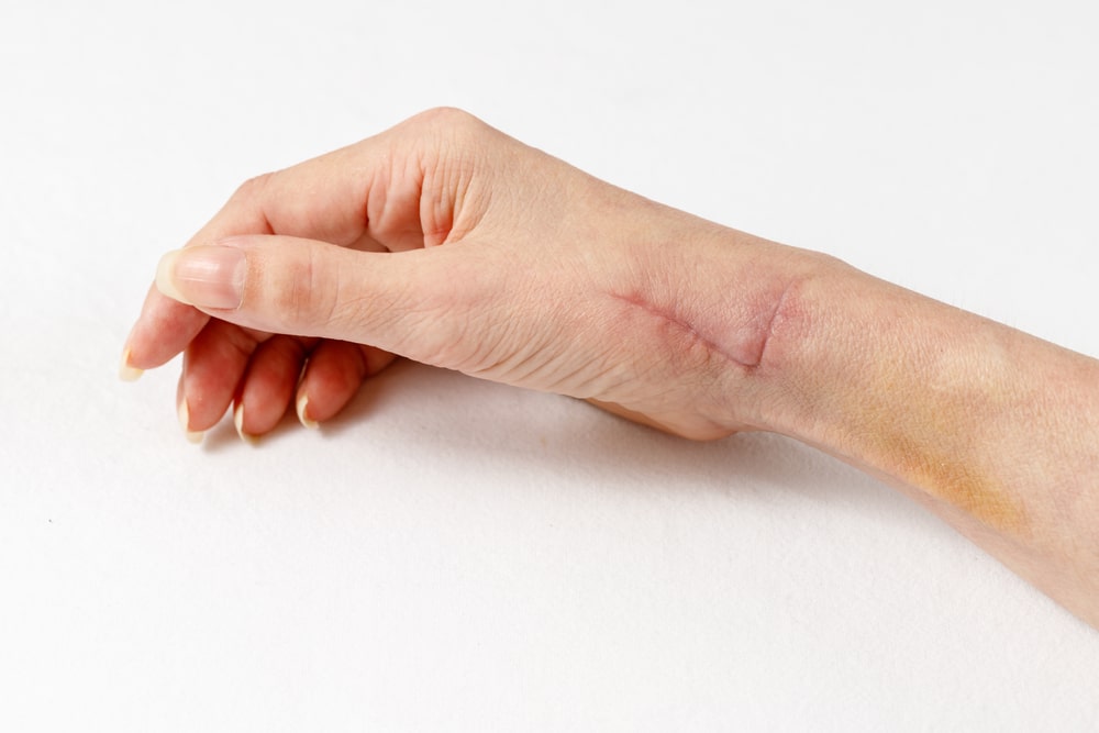 A fresh healing scar one month after surgery on tendons and radial nerve