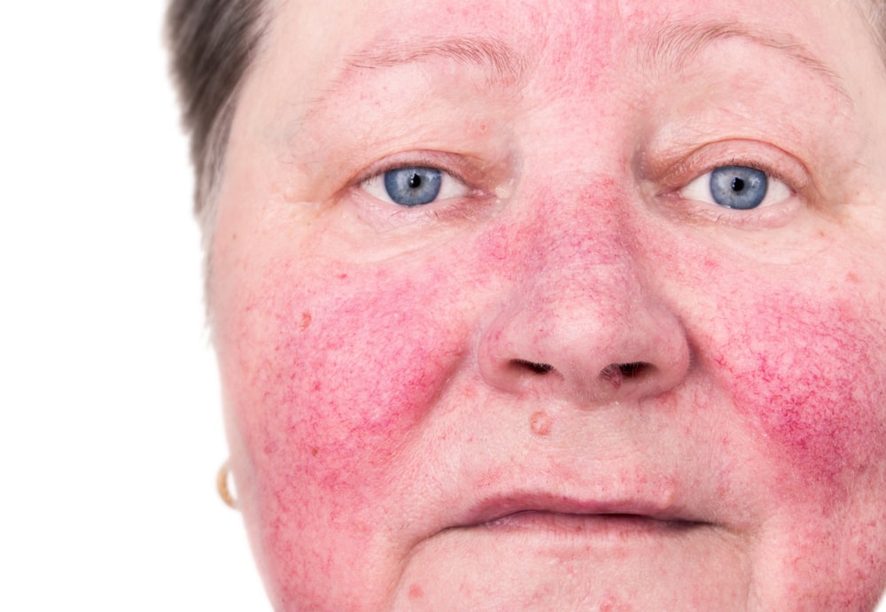 An elderly woman with skin rosacea condition