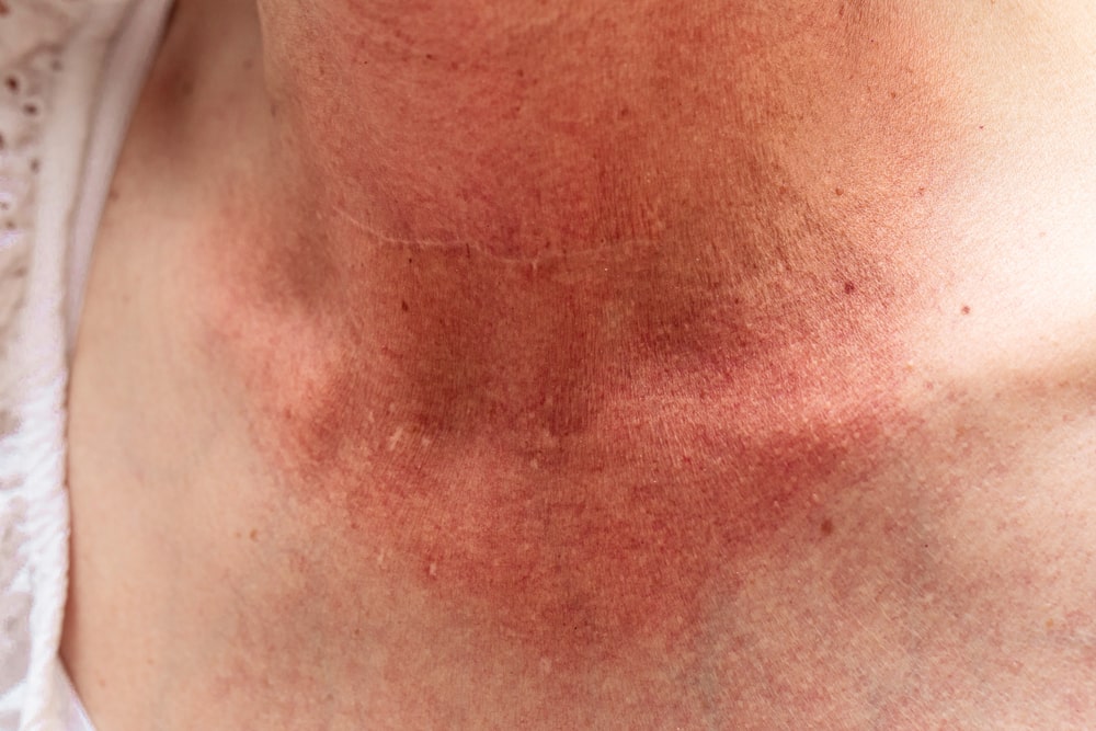 A closeup view on the sunburned skin of a caucasian lady