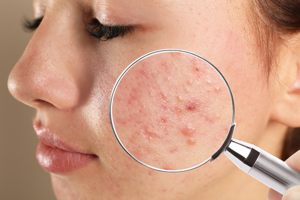 Teenage girl with acne problem visiting dermatologist, closeup