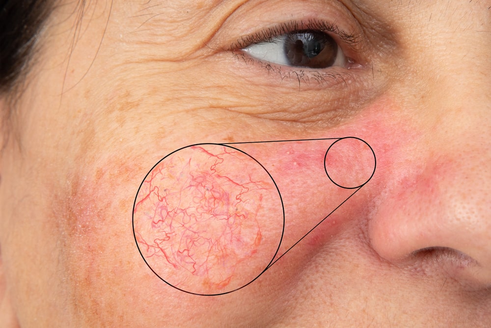 Closeup of red and swollen capillaries on the face of a Caucasian lady