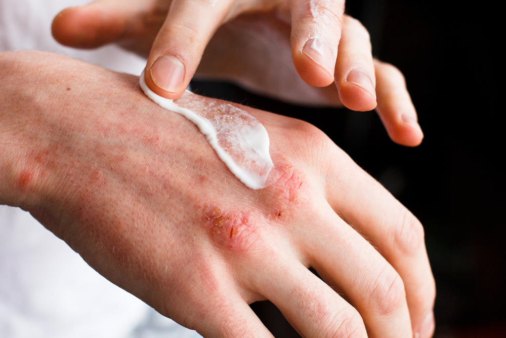 5 Tips to Prevent Eczema Flare-Ups